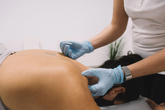 A patient lying face down on a medical exam table with a physical therapist above them inserting a dry needle into the patient's shoulder. 