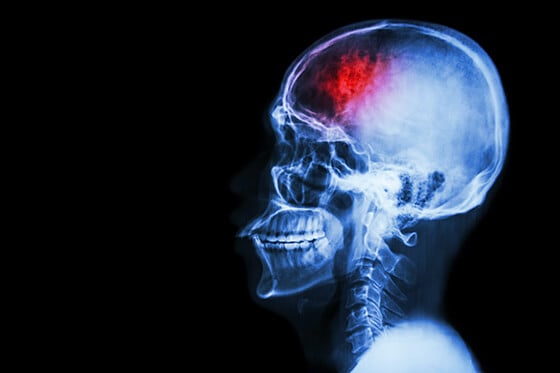 An X-Ray example of a concussion.